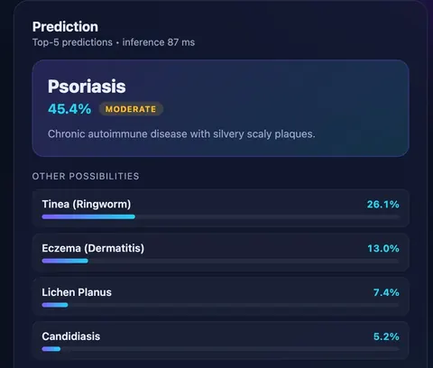 Demo output of the in-browser skin disease detection app: the top result with confidence and severity, ranked alternatives and an 87 ms inference time.