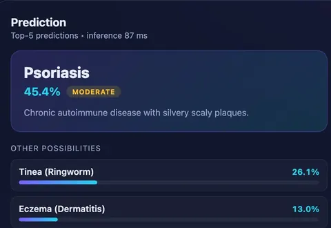 Prediction panel of the in-browser skin disease detection app: the top result with confidence and severity, ranked alternatives and an 87 ms inference time.