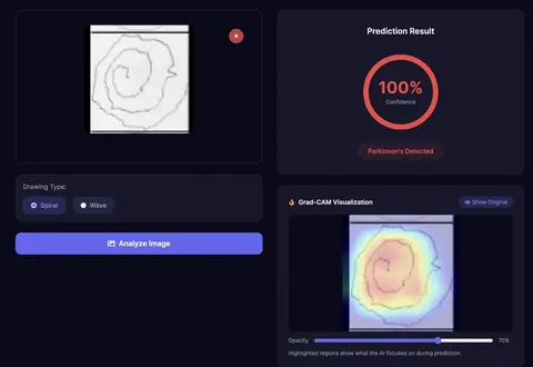 Web app result screen: a spiral drawing is classified, with a confidence gauge and a Grad-CAM heatmap showing where the model focused.