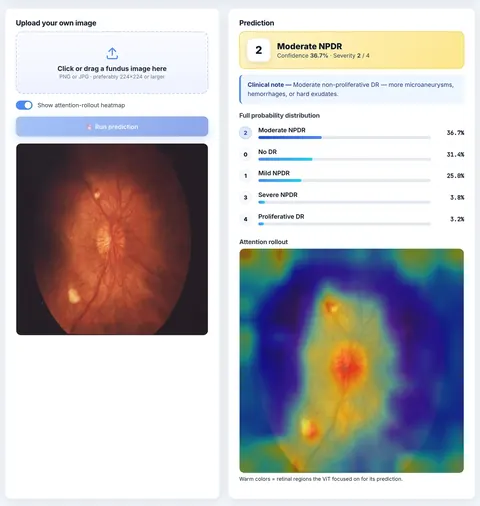 Delivered M.Tech deep learning project: a retinopathy web app grades an uploaded fundus image as Moderate NPDR, with a probability bar for each of the five grades and an attention-rollout heatmap.