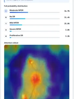 Live prediction in the web app: an uploaded fundus image is graded 'Moderate NPDR', with a probability bar for each of the 5 severity grades and an attention-rollout heatmap showing where the model looked.