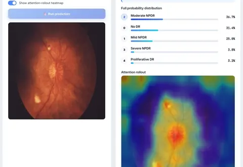 Live prediction in the web app: an uploaded fundus image is graded 'Moderate NPDR', with a probability bar for each of the 5 severity grades and an attention-rollout heatmap showing where the model looked.